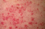 Dermatitis/Eczema