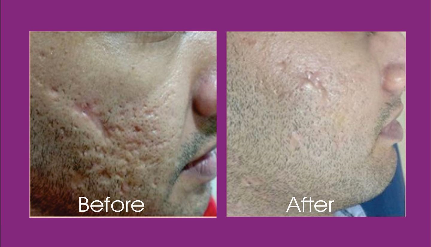 Skin Resurfacing Acne Skin Reduction